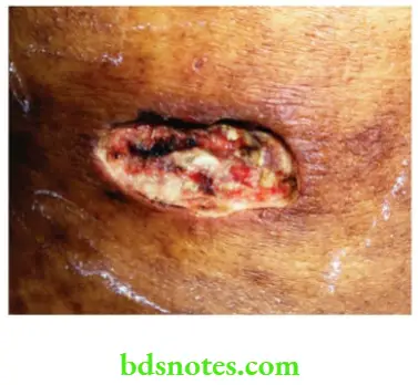 Acute Infections After excision of the carbuncle wound heals within 2 to 3 weeks