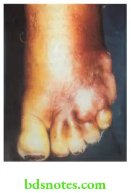 Acute Infections Cellulitis of the foot with abscess