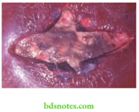 Acute Infections Observe central slough and cruciate incision