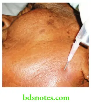 Acute Infections Parotid abscess classically will not give rise to fluctuation.