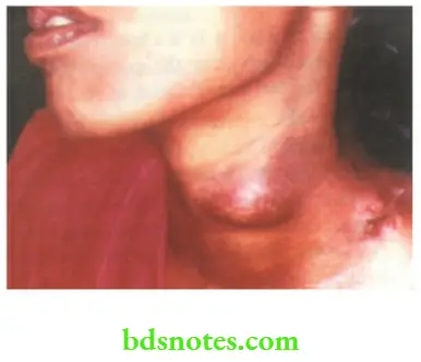 Acute Infections TB lymphadenitis Cold abscess
