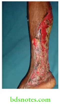 Acute Infections This patient presented with features of cellulitis with renal failure. There were no precipitating factors. After debridement recovery was complete