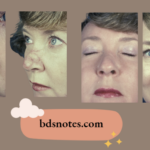 Basal Cell Carcinoma Nasolabial Fold