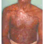 Burns Skin Grafting And Flaps Postburn contracture in an adult