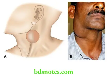 Examination of Swellings, Tumours, Cysts and Neck Swelling Branchial cyst Half in front half behind sternocleidomastoid muscle and Classical branchial cyst