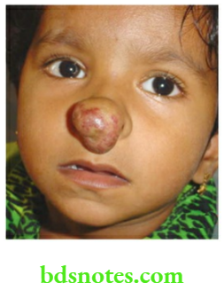 Examination of Swellings, Tumours, Cysts and Neck Swelling Capillary haemangioma of the nose