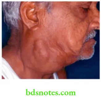 Examination of Swellings, Tumours, Cysts and Neck Swelling Carotid body tumour classical site