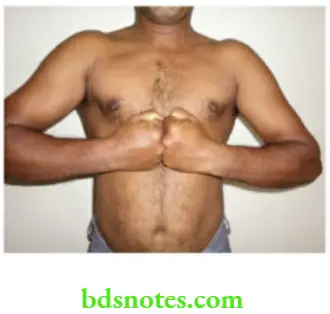 Examination of Swellings, Tumours, Cysts and Neck Swelling Contraction of pectoralis major