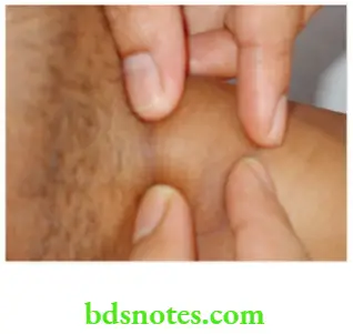 Examination of Swellings, Tumours, Cysts and Neck Swelling Fluctuation test by four fingers method