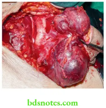 Examination of Swellings, Tumours, Cysts and Neck Swelling Hugely enlarged lymph nodes which are bluish in colour, pushing the carotid arteries anteriorly papillary carcinoma thyroid