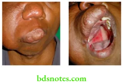 Examination of Swellings, Tumours, Cysts and Neck Swelling Large haemangioma involving cheek, lip and palate he also had