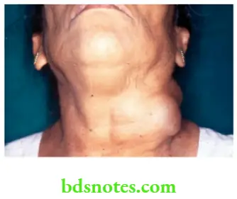 Examination of Swellings, Tumours, Cysts and Neck Swelling Level 5 node post-cricoid carcinoma