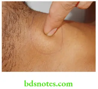 Examination of Swellings, Tumours, Cysts and Neck Swelling Pagets test for a small swelling