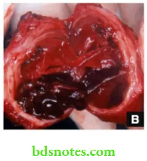 Examination of Swellings, Tumours, Cysts and Neck Swelling Radial artery aneurysm with clot excised specimen.