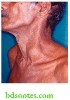 Examination of Swellings, Tumours, Cysts and Neck Swelling Scalene node - in between the two heads of sternomastoid a case of bronchogenic carcinoma