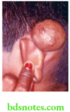 Examination of Swellings, Tumours, Cysts and Neck Swelling Sign of compressibility was positive in this case. It was initially diagnosed as postauricular dermoid cyst