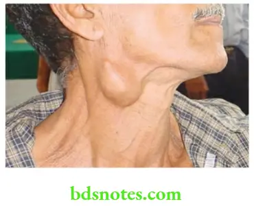 Examination of Swellings, Tumours, Cysts and Neck Swelling Swelling mimicked branchial cyst.