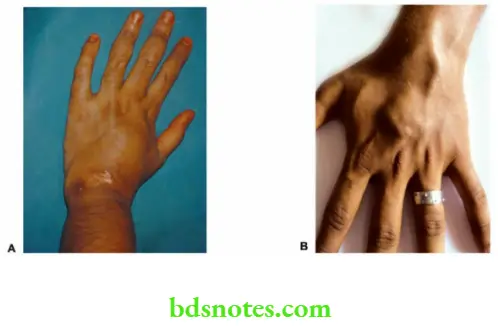 Examination of Swellings, Tumours, Cysts and Neck Swelling Traumatic AV fistula affecting wrist and hand. Kindly observe prominent veins and swollen fingers