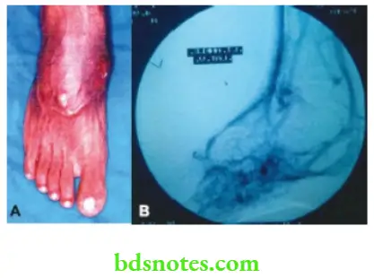 Examination of Swellings, Tumours, Cysts and Neck Swelling Traumatic AV fistula see the arterialisation of the vein