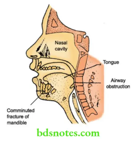 Classification of Maxillofacial Injuries Notes - BDS Notes