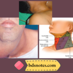 Hodgkins Lymphoma Cervical Lymphadenopathy Firm Rubbery Nodes