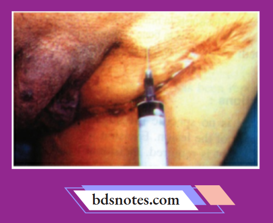 Inguinal Region Injection