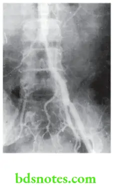 Lower Limb Ischaemia Angiography showing block in the common iliac artery on the right side