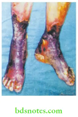 Lower Limb Ischaemia Bilateral gangrene due to atherosclerosis