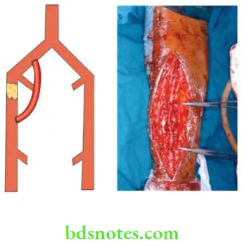 Lower Limb Ischaemia Iliofemoral graft by using reversed saphenous vein