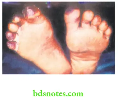 Lower Limb Ischaemia Vasculitis with collagen vascular disorder. It had affected all the ten toes