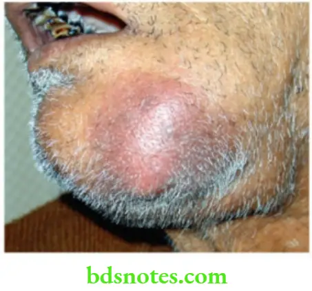 Oral Cavity, Odontomes, Lip And Palate Advamced carcinoma floor of the mouth with inflartion in to the skin