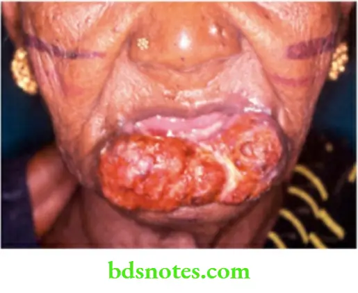 Oral Cavity, Odontomes, Lip And Palate Advanced carcinoma lip a proliferative lesion treated with radiation