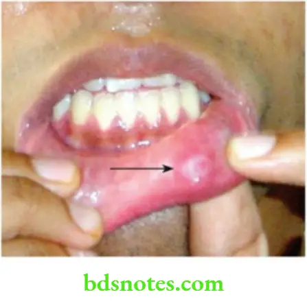 Oral Cavity, Odontomes, Lip And Palate Athin Walled cystic small swelling in the bucal muscosa or in the lips is most likely to be a muscus cyst
