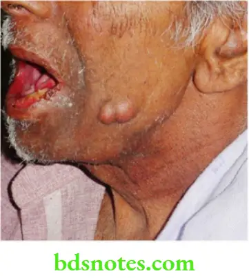 Oral Cavity, Odontomes, Lip And Palate CArcinoma Cheek With Infilaration Into The skin