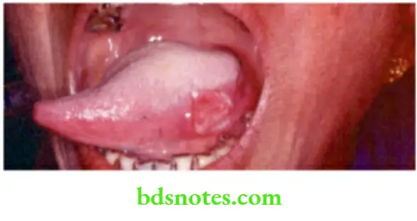Oral Cavity, Odontomes, Lip And Palate CArcinoma Lateral border the most common site