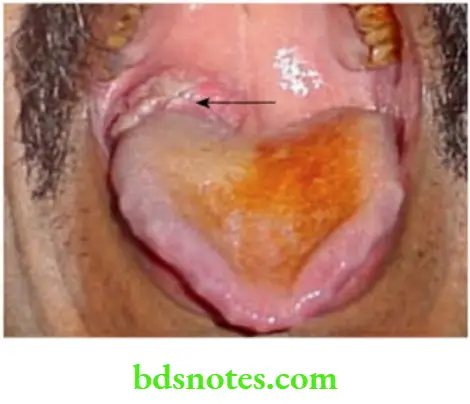 Oral Cavity, Odontomes, Lip And Palate Carcinoma Posterior
