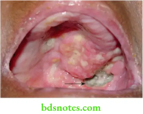 Oral Cavity, Odontomes, Lip And Palate Carcinoma alvelous