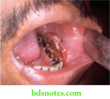 Oral Cavity, Odontomes, Lip And Palate Carcinoma alveolar margin