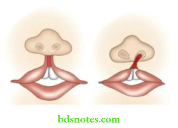Oral Cavity, Odontomes, Lip And Palate Cleft lip