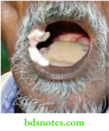 Oral Cavity, Odontomes, Lip And Palate Exophytic growth is a verrucous carcinoma