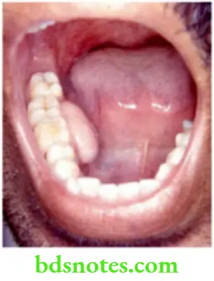 Oral Cavity, Odontomes, Lip And Palate Fibrous Epulis