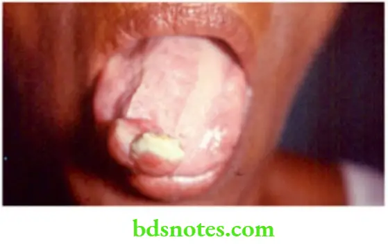 Oral Cavity, Odontomes, Lip And Palate Frozen tounge