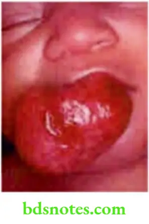 Oral Cavity, Odontomes, Lip And Palate Granulomatous Epulis