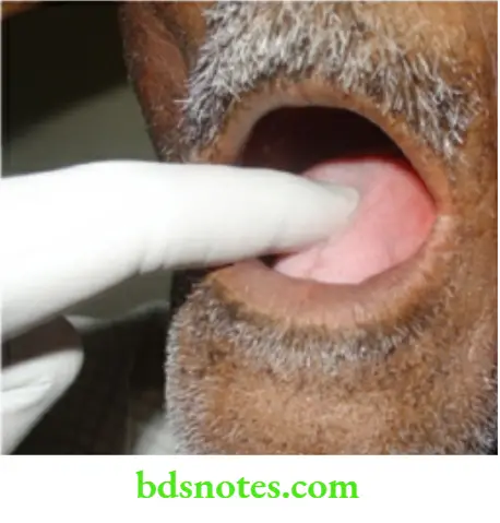 Oral Cavity, Odontomes, Lip And Palate Induration of the tounge to be checked with tounge i nside the oral cavity