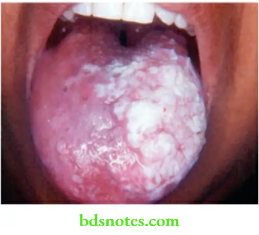 Oral Cavity, Odontomes, Lip And Palate Leukoplakia of the tongue—biopsy is a must to rule out carcinoma