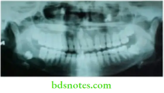 Oral Cavity, Odontomes, Lip And Palate Orthopantomogram Showing Unerupted Tooth