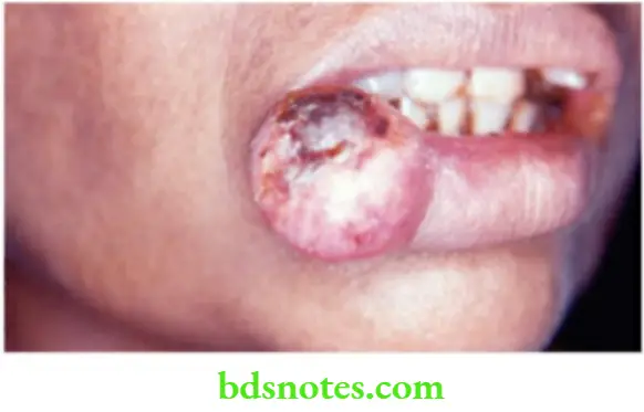 Oral Cavity, Odontomes, Lip And Palate This lesion was dignosed as carcinoma lip.