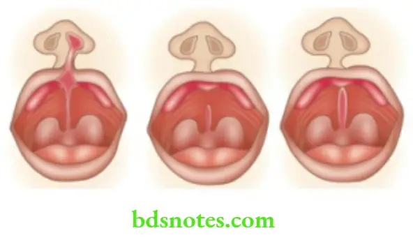 Oral Cavity, Odontomes, Lip And Palate Types Of cleft Palate