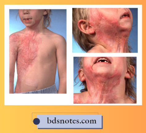 Postburn Neck Contracture Child Skin Grafting