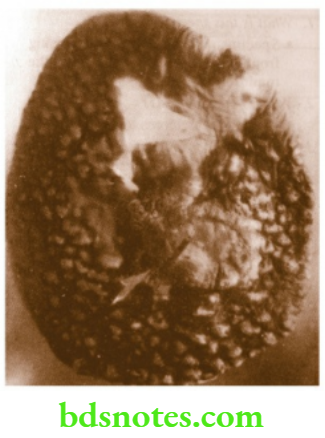 Specimens Marjolin's ulcer